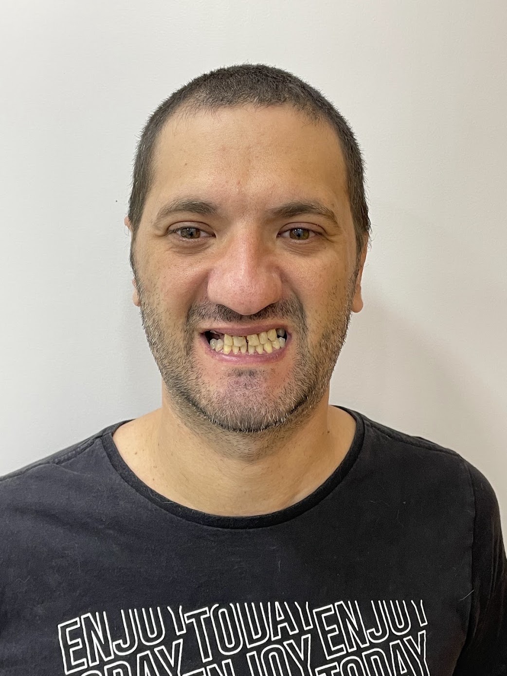 Caso 3 — Implante Dentário Antes